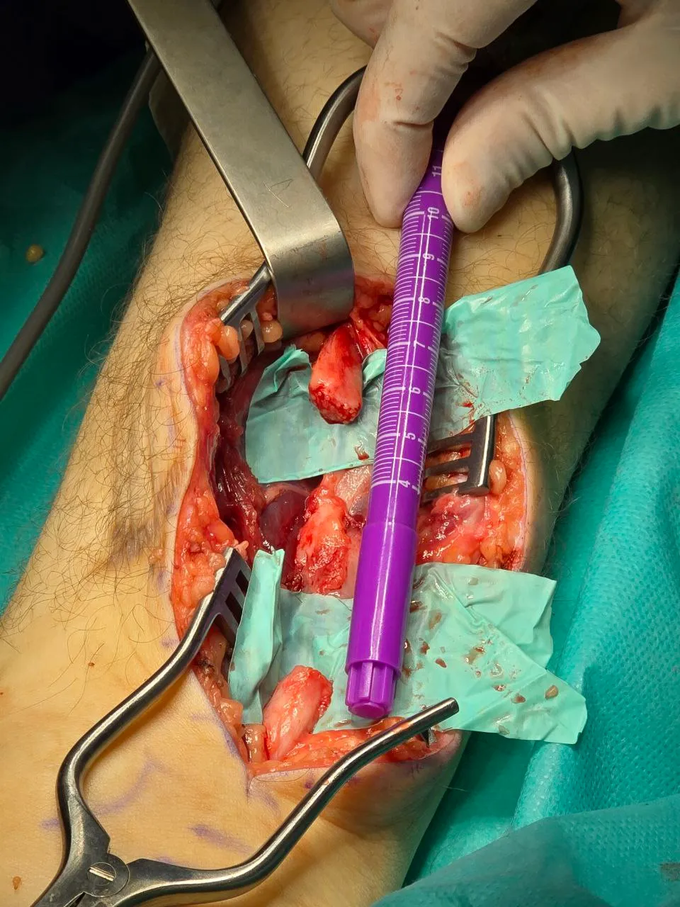 Микрохирургическое восстановление нервов